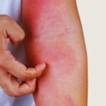 Alergijski osip na ruci praćen svrabom i crvenilom